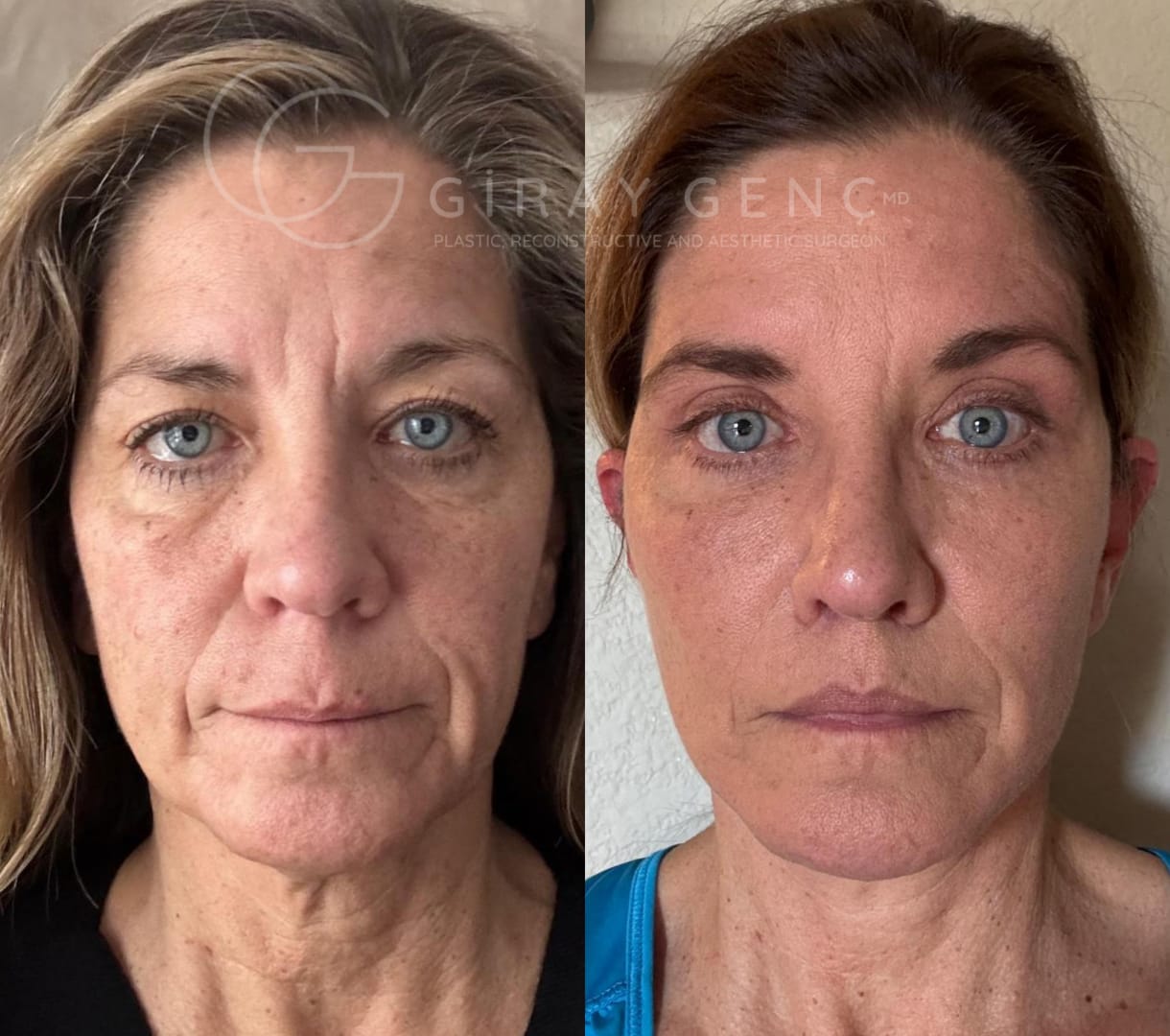 facial reconstruction before and after photos, showing surgery day and 6-month healing process by Dr. Giray Genc.