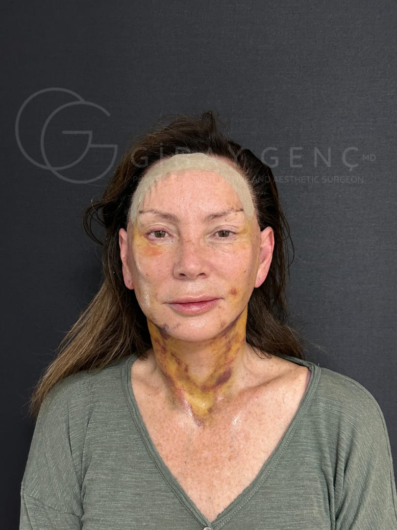 Healing progress after facial reconstruction, comparison between 2 weeks and 3 months by Dr. Giray Genc.