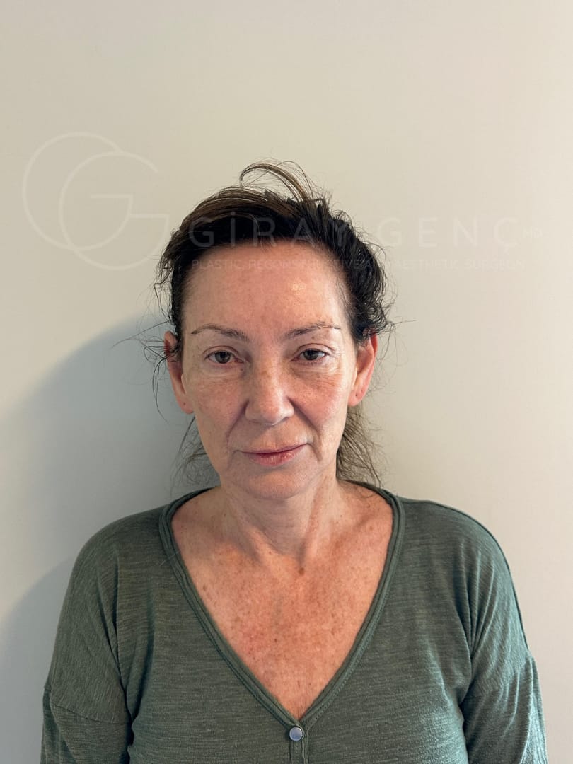 Before and after facial reconstruction photos, showing natural, life-changing results by Dr. Giray Genc.