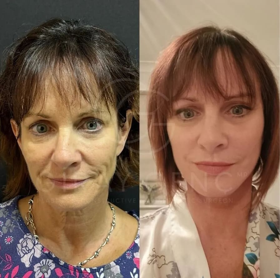 Before and after results of facelift and necklift surgery showing natural, youthful appearance.