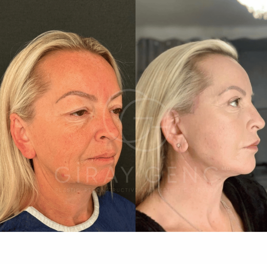 Deep Plane Face and Necklift + Eyelid Surgery