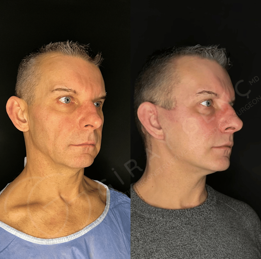 Face and Necklift + Fat Transfer+ liplift