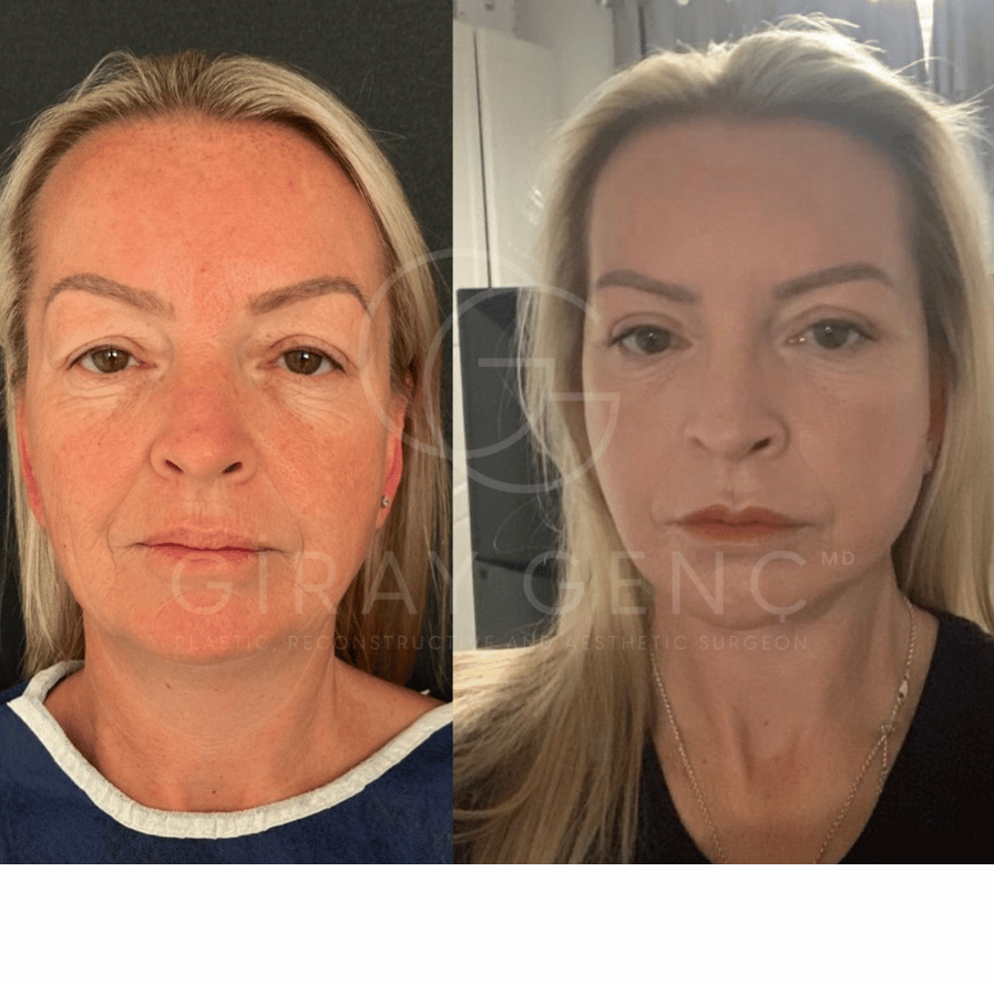Deep Plane Face and Necklift + Eyelid Surgery