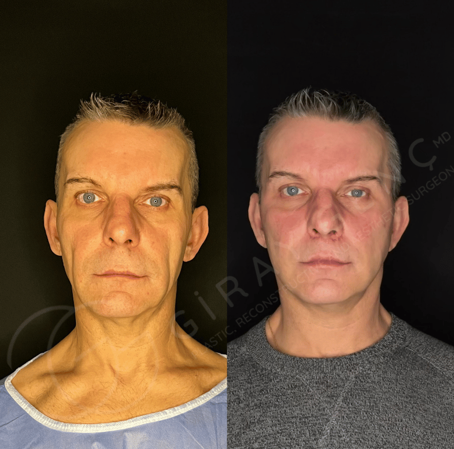 Face and Necklift + Fat Transfer+ liplift
