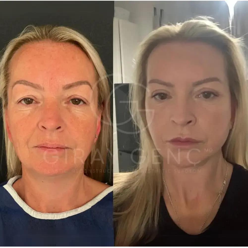 Face & Neck Lift