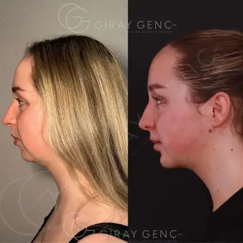 Chin implant, Double Chin Lipo & Buccal fat Removal