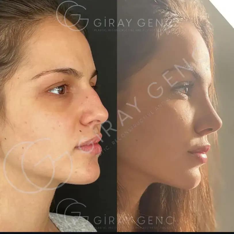 Rhinoplasty