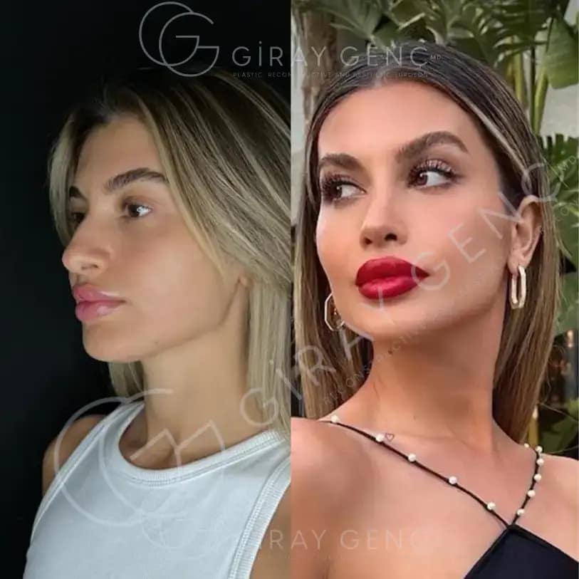 Rhinoplasty