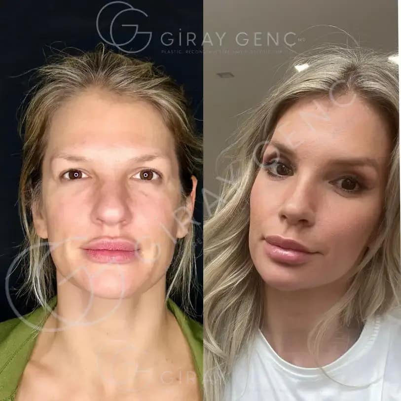 Rhinoplasty & Eyelid