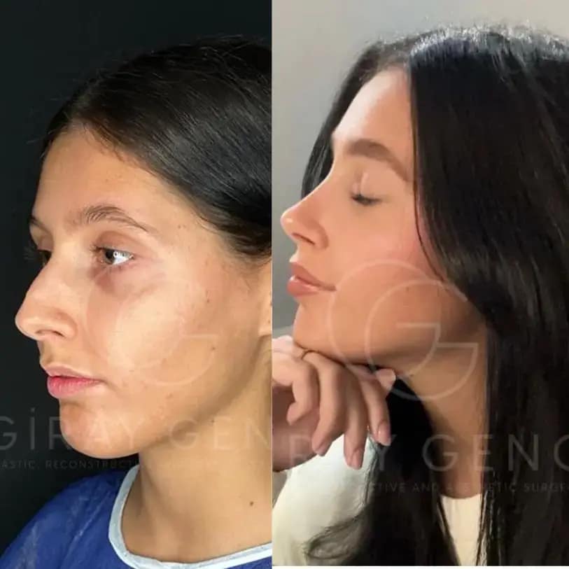 Rhinoplasty