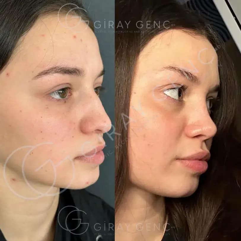 Rhinoplasty