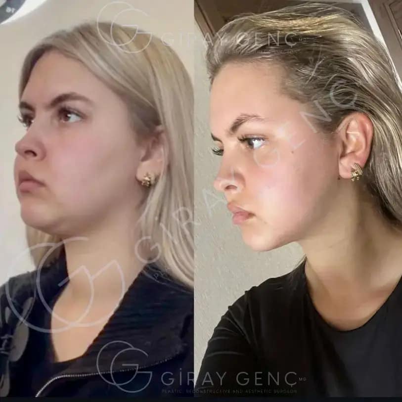 Double Chin Lipo & Buccal Fat Removal