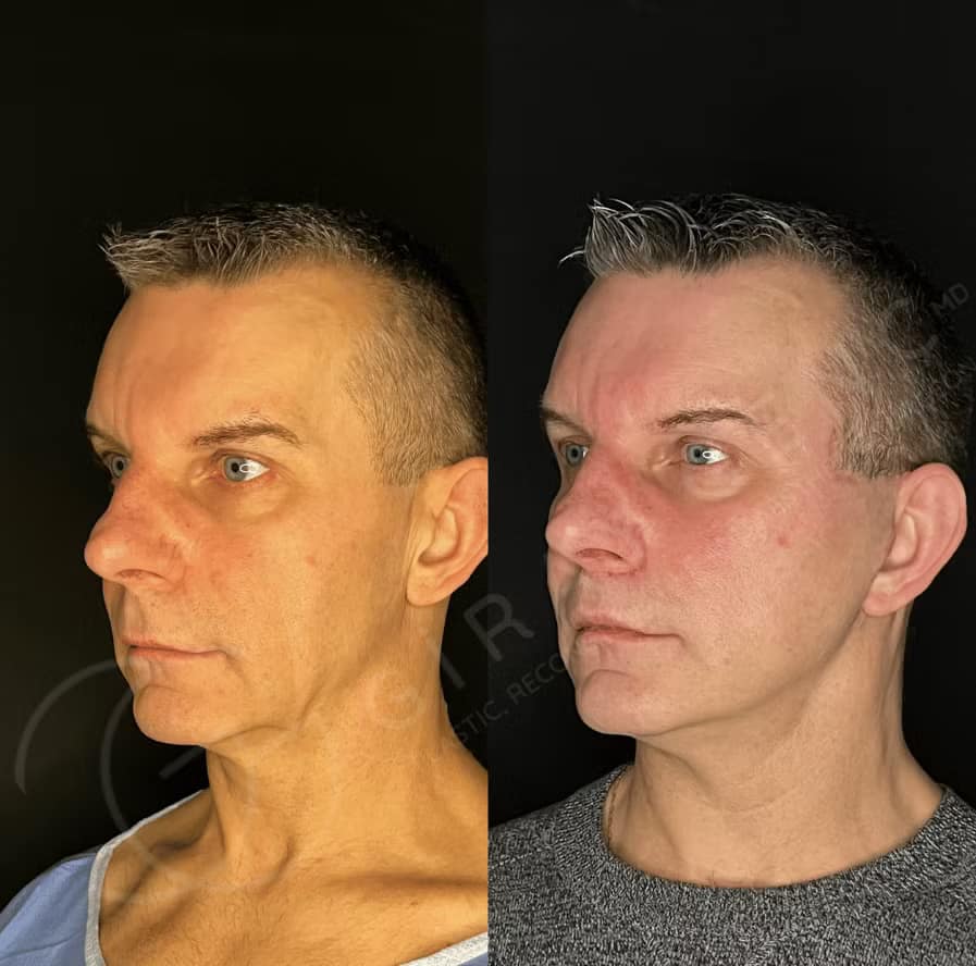 Face & Neck Lift