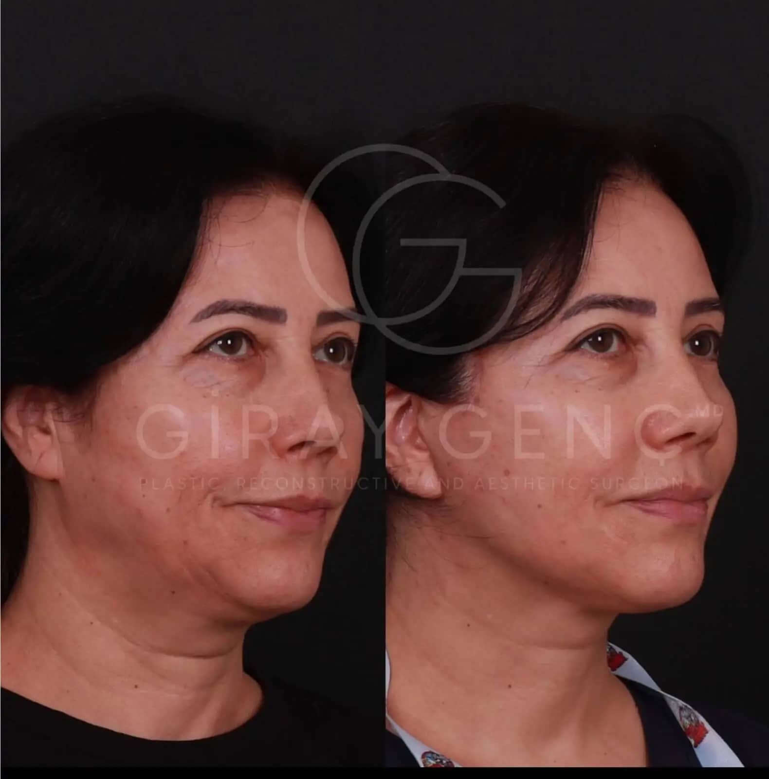 Face and Necklift