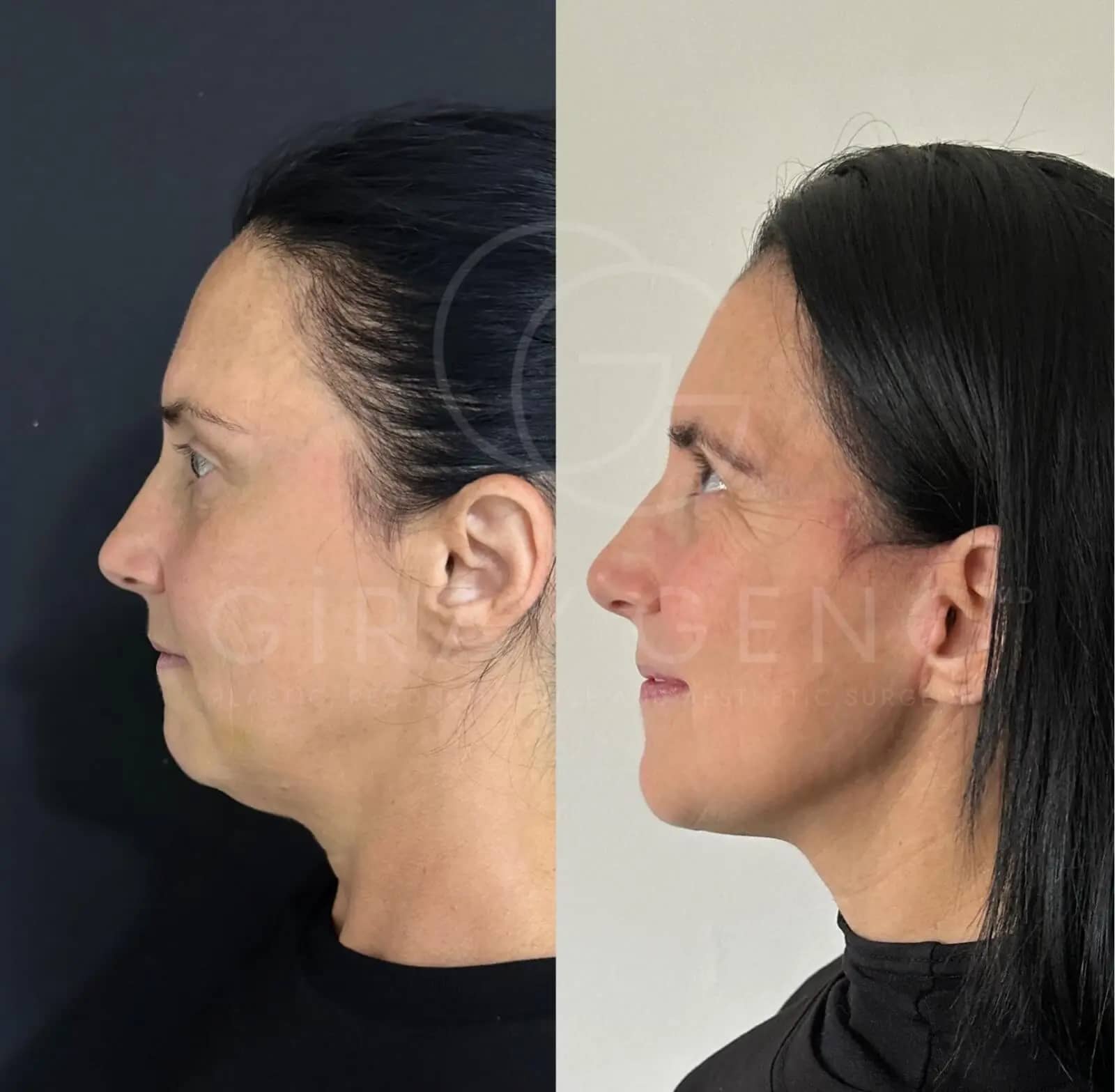 Face and Necklift
