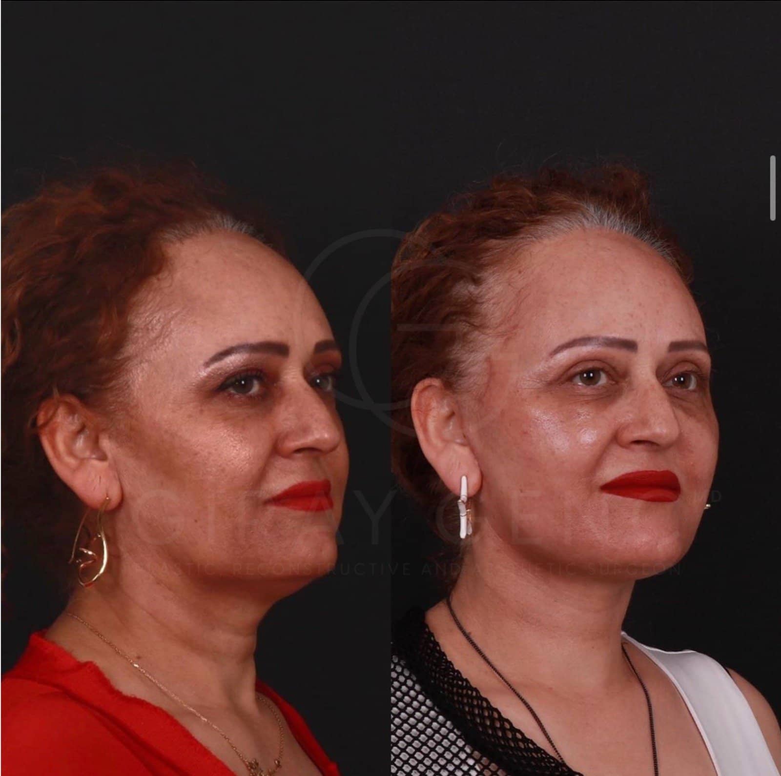 Deep Plane Face and Necklift + Eyelid Surgery