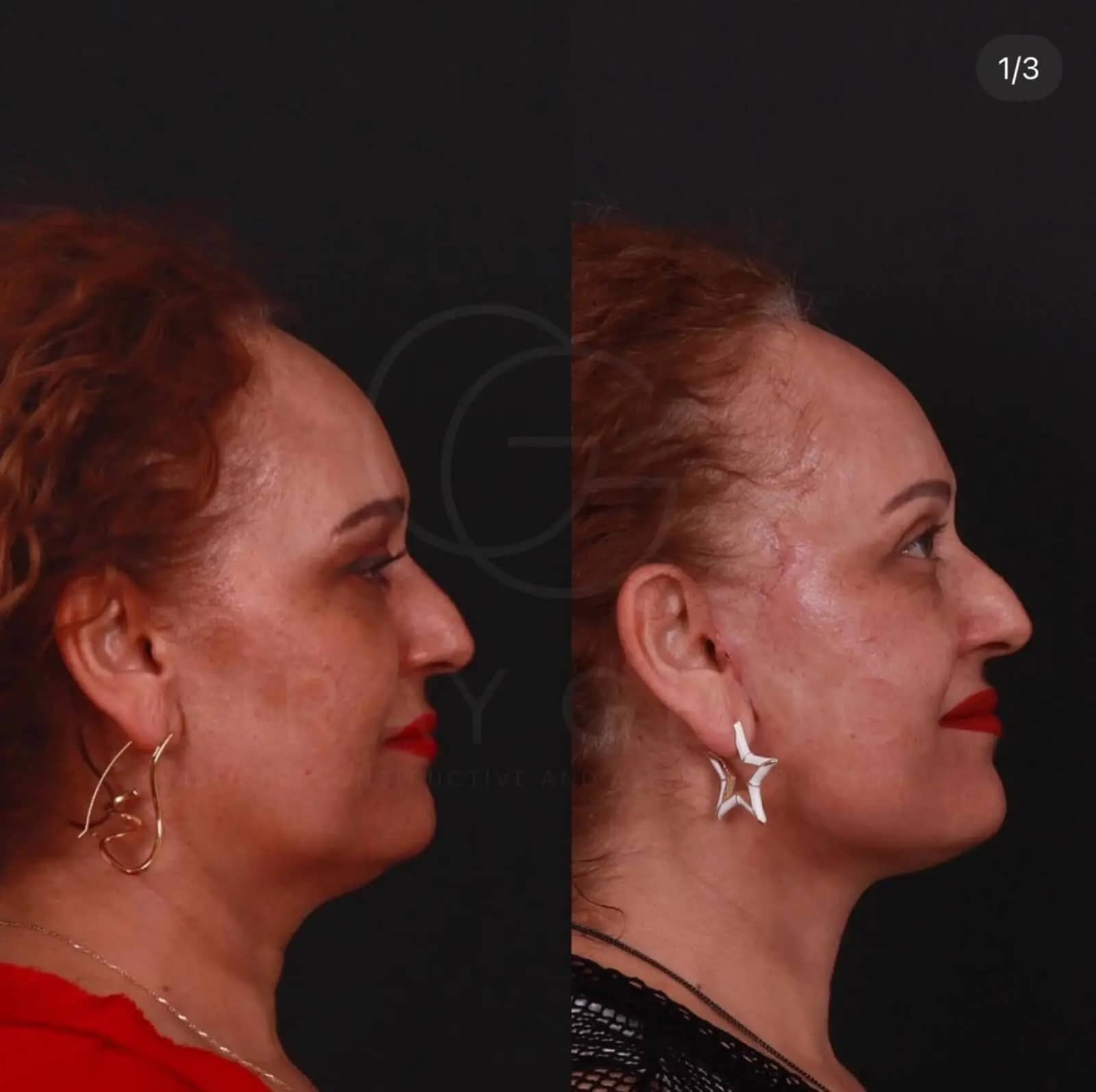 Deep Plane Face and Necklift + Eyelid Surgery