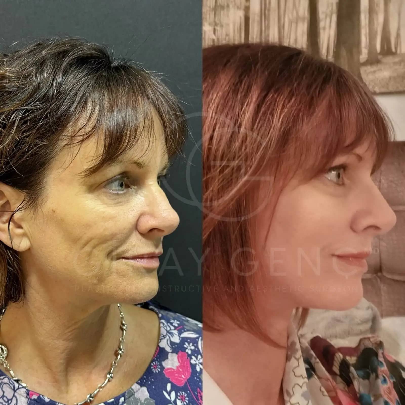 Deep Plane Face and Necklift + Fat Transfer